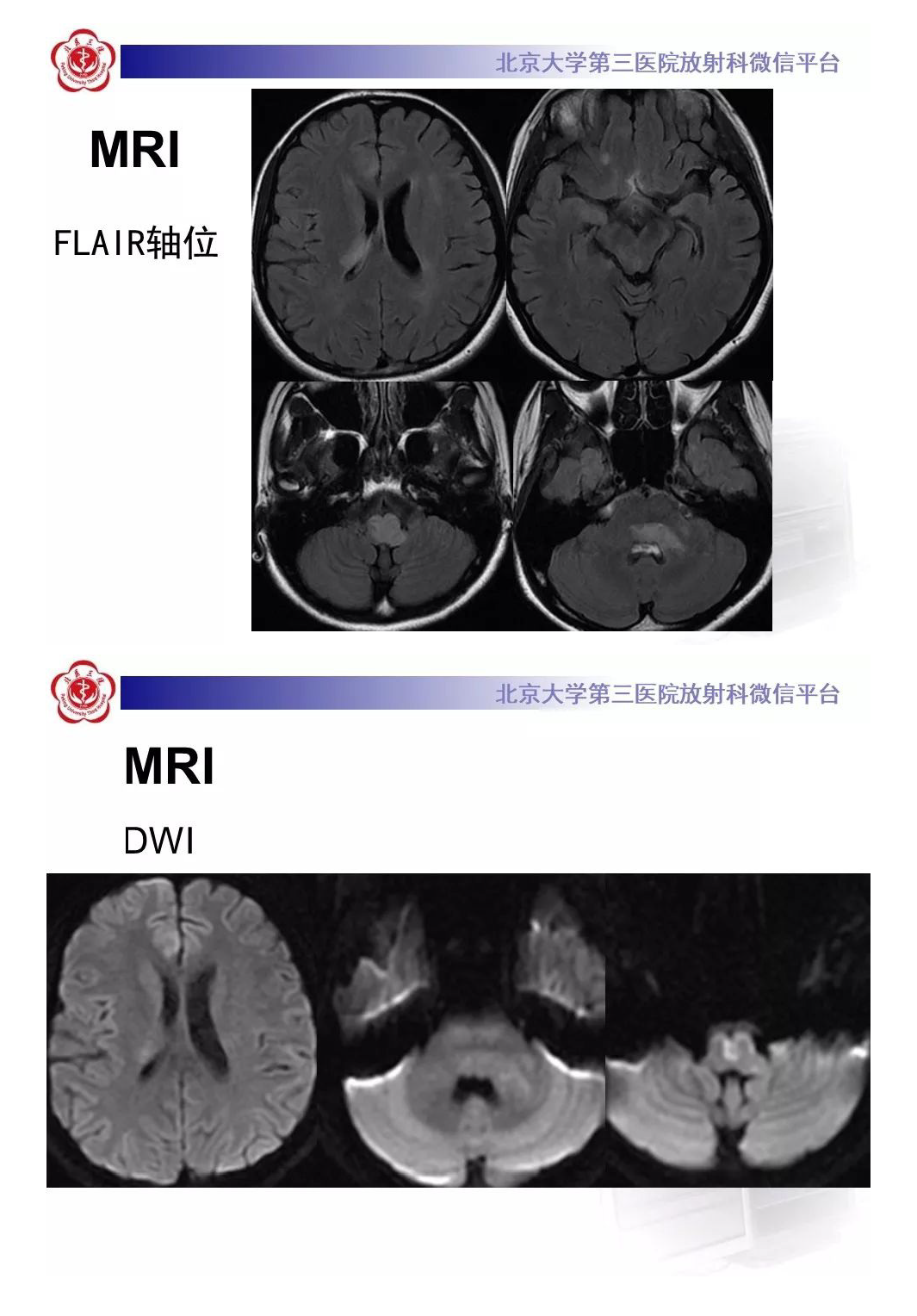 影像PPT - 【PPT】急性播散性脑脊髓炎-3