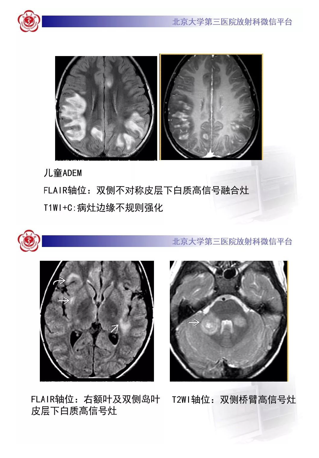 影像PPT - 【PPT】急性播散性脑脊髓炎-10