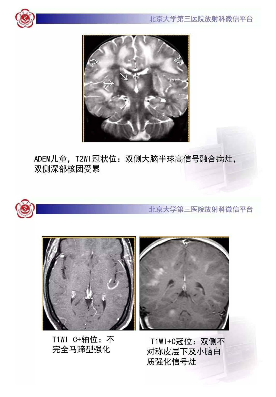 影像PPT - 【PPT】急性播散性脑脊髓炎-11