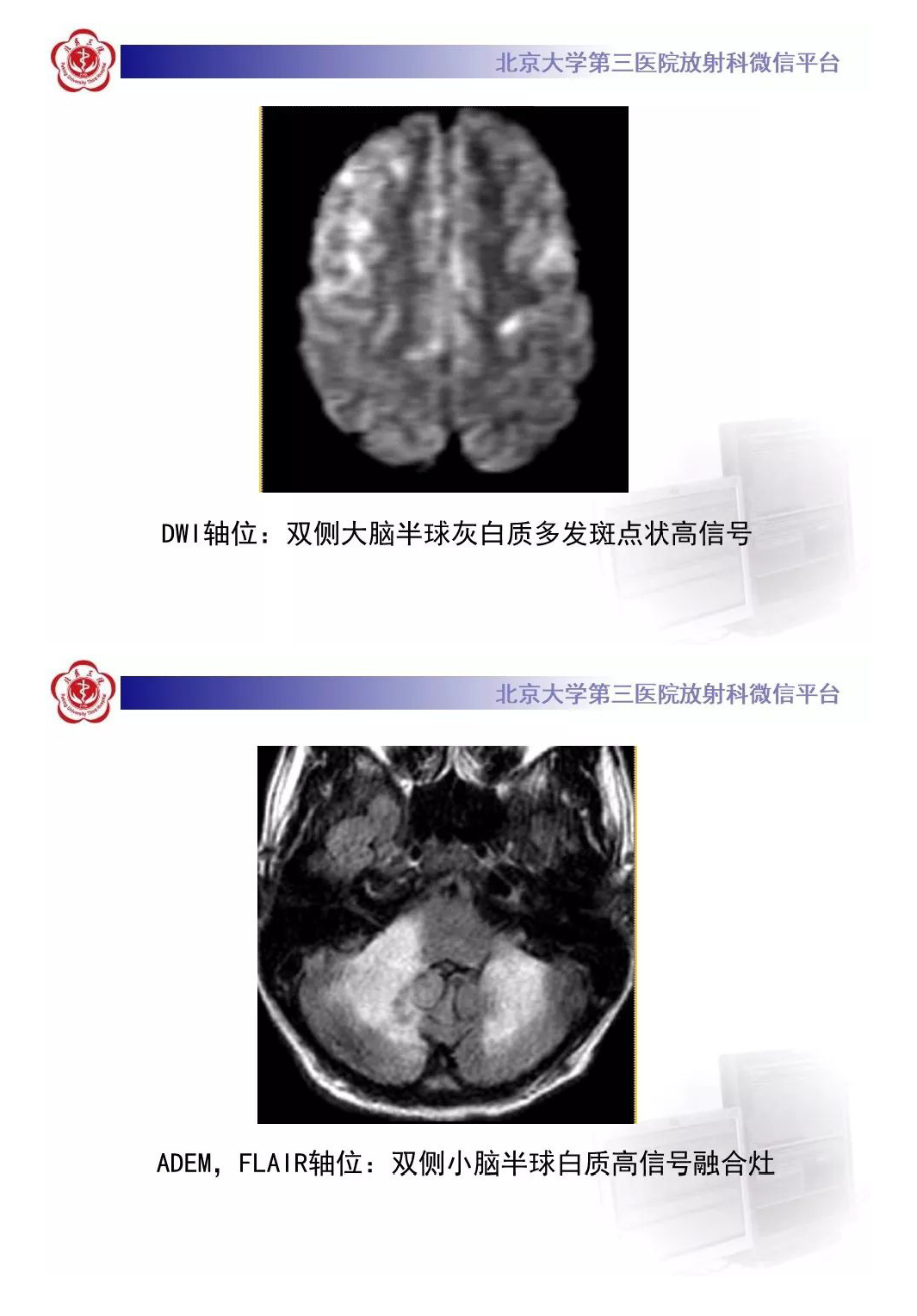 影像PPT - 【PPT】急性播散性脑脊髓炎-12
