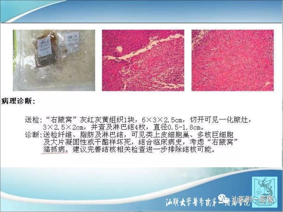 影像PPT - 【病例】猫抓病1例MR影像-7