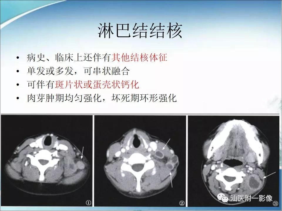 影像PPT - 【病例】猫抓病1例MR影像-15