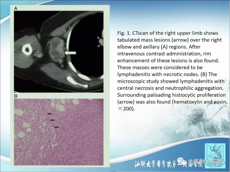 影像PPT - 【病例】猫抓病1例MR影像-13