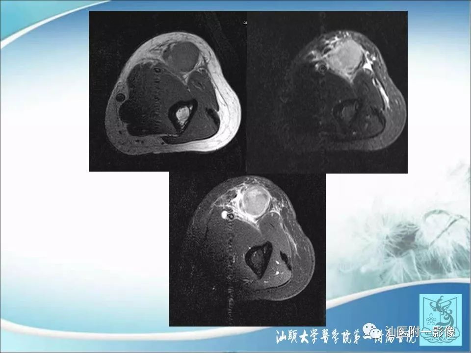影像PPT - 【病例】猫抓病1例MR影像-12