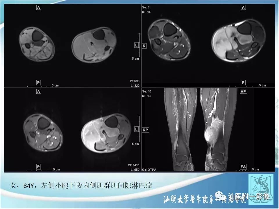 影像PPT - 【病例】猫抓病1例MR影像-20
