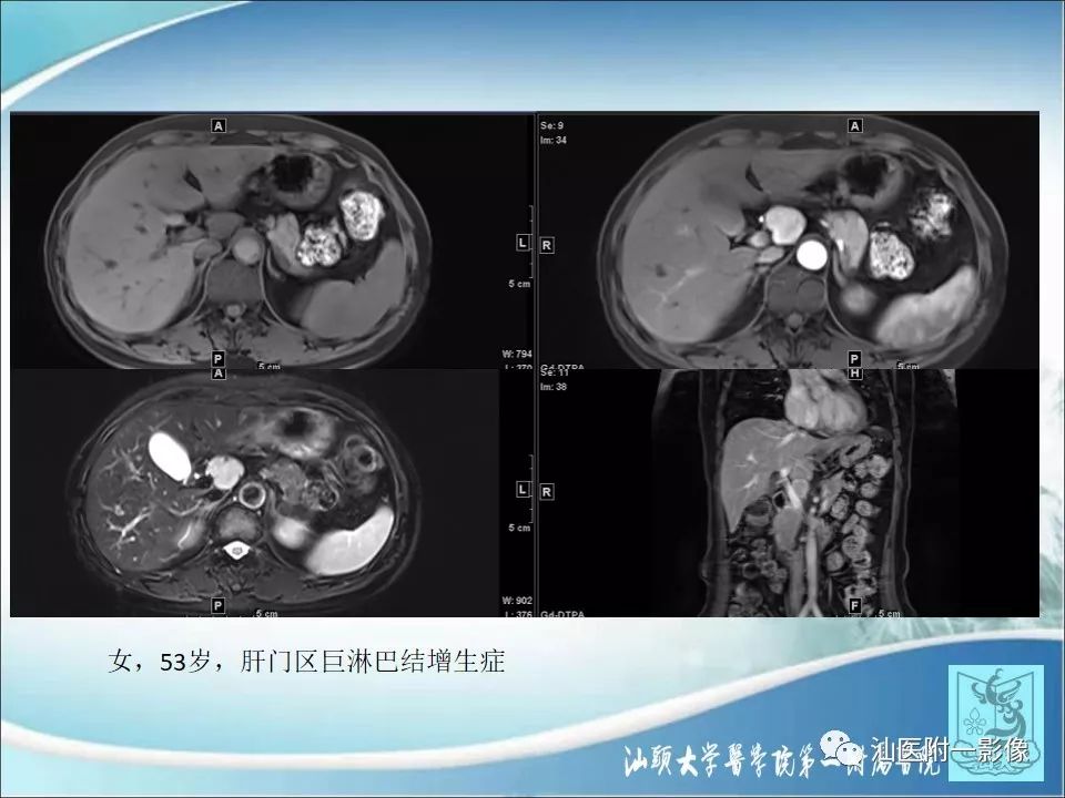 影像PPT - 【病例】猫抓病1例MR影像-18