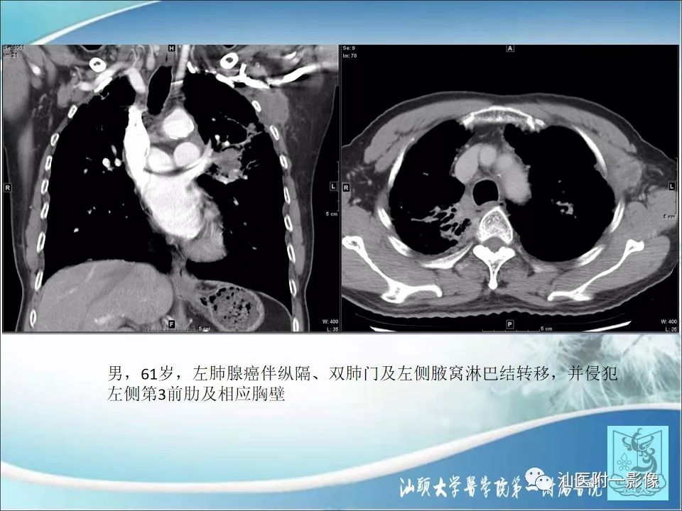 影像PPT - 【病例】猫抓病1例MR影像-22