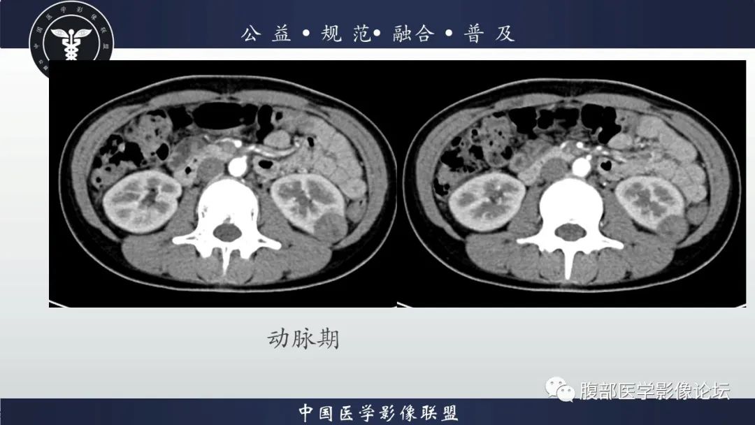 影像PPT - 【病例】肾球旁细胞瘤1例CT及MR影像诊断-5