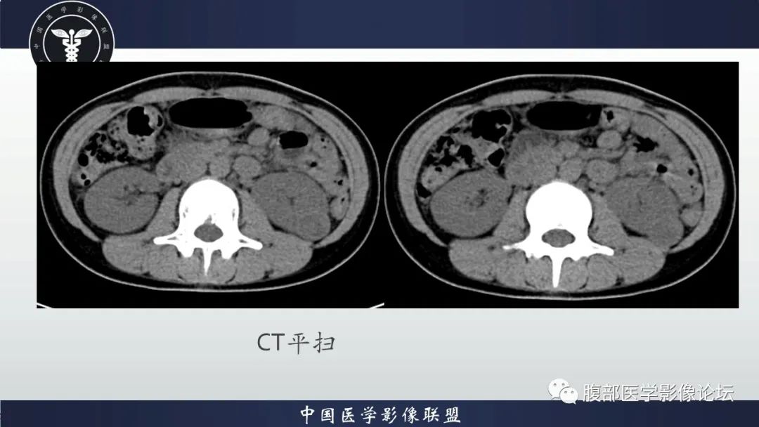 影像PPT - 【病例】肾球旁细胞瘤1例CT及MR影像诊断-4