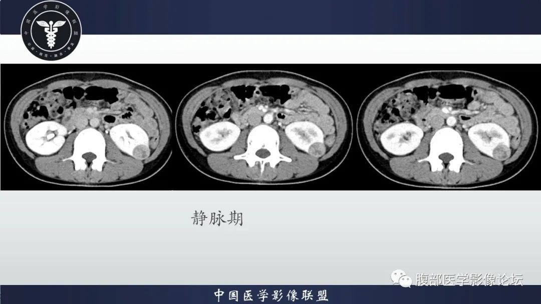 影像PPT - 【病例】肾球旁细胞瘤1例CT及MR影像诊断-6