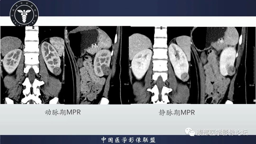 影像PPT - 【病例】肾球旁细胞瘤1例CT及MR影像诊断-7
