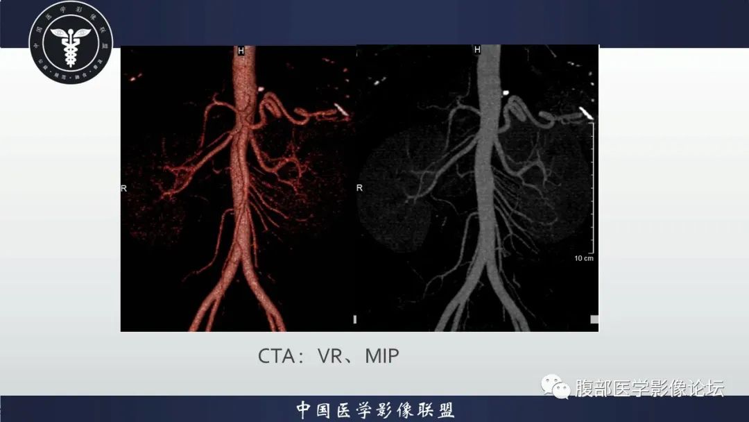 影像PPT - 【病例】肾球旁细胞瘤1例CT及MR影像诊断-8