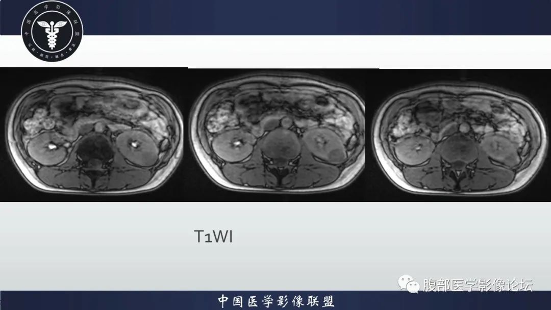 影像PPT - 【病例】肾球旁细胞瘤1例CT及MR影像诊断-9