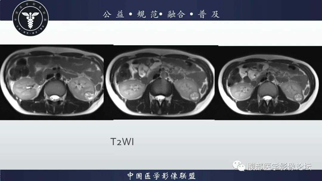影像PPT - 【病例】肾球旁细胞瘤1例CT及MR影像诊断-10
