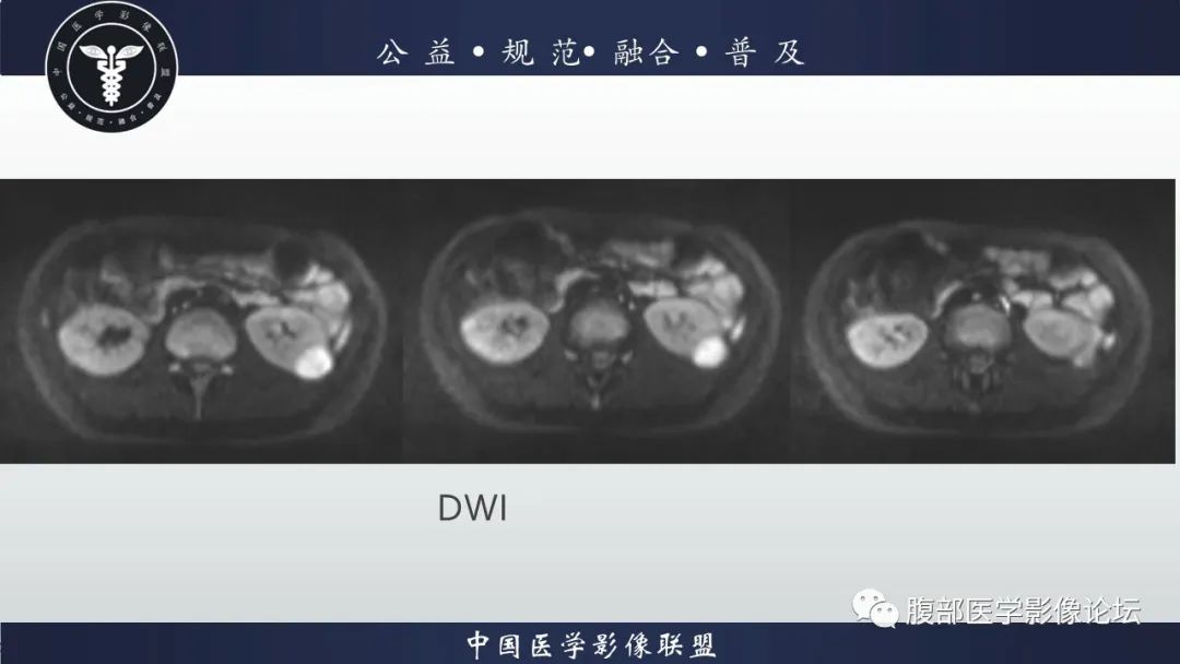 影像PPT - 【病例】肾球旁细胞瘤1例CT及MR影像诊断-11