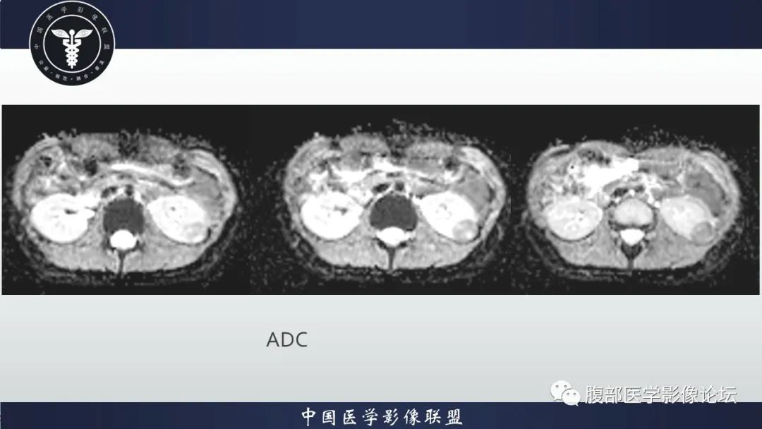 影像PPT - 【病例】肾球旁细胞瘤1例CT及MR影像诊断-12