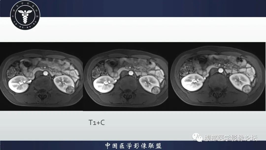 影像PPT - 【病例】肾球旁细胞瘤1例CT及MR影像诊断-13