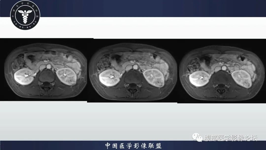 影像PPT - 【病例】肾球旁细胞瘤1例CT及MR影像诊断-14