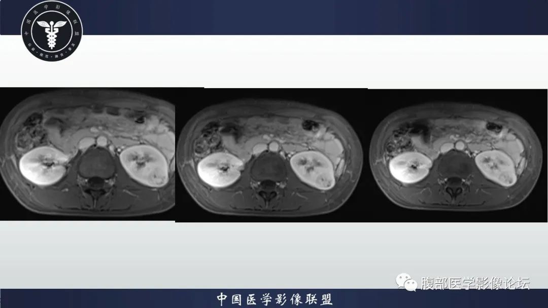 影像PPT - 【病例】肾球旁细胞瘤1例CT及MR影像诊断-15