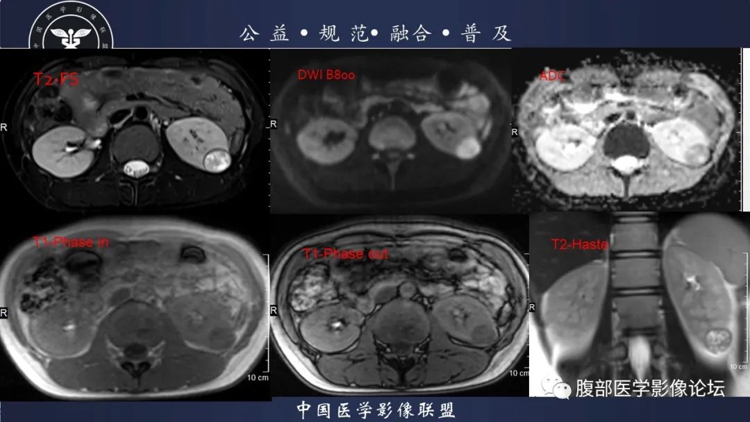 影像PPT - 【病例】肾球旁细胞瘤1例CT及MR影像诊断-16