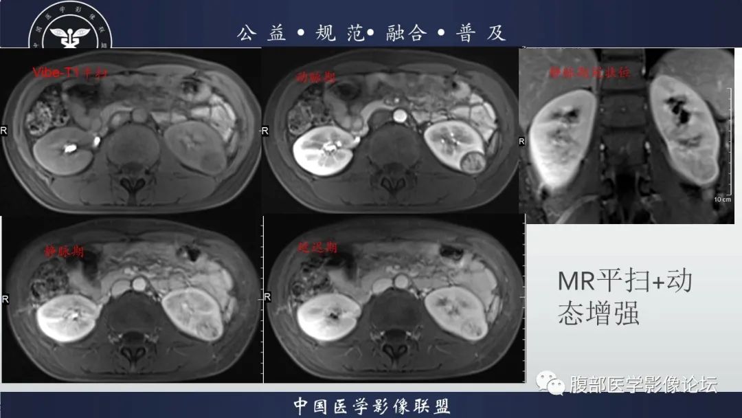 影像PPT - 【病例】肾球旁细胞瘤1例CT及MR影像诊断-17