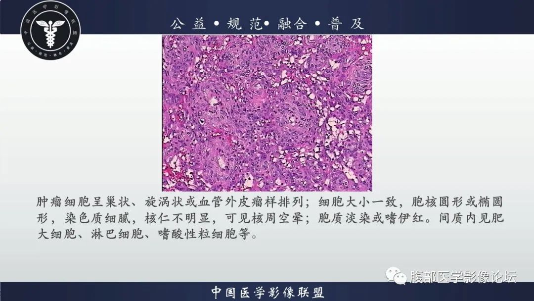 影像PPT - 【病例】肾球旁细胞瘤1例CT及MR影像诊断-21