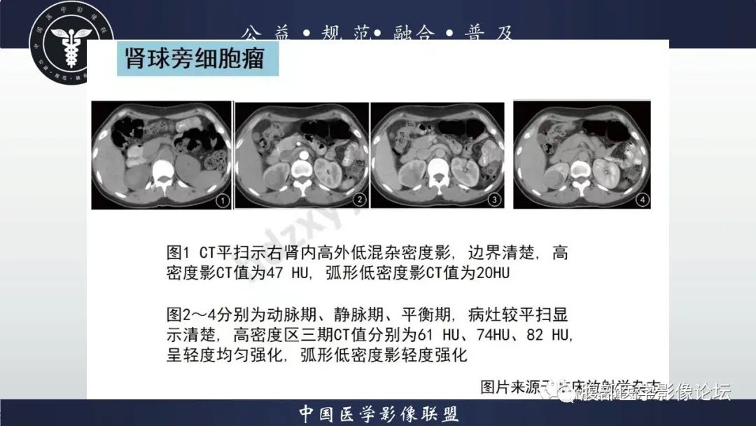 影像PPT - 【病例】肾球旁细胞瘤1例CT及MR影像诊断-26