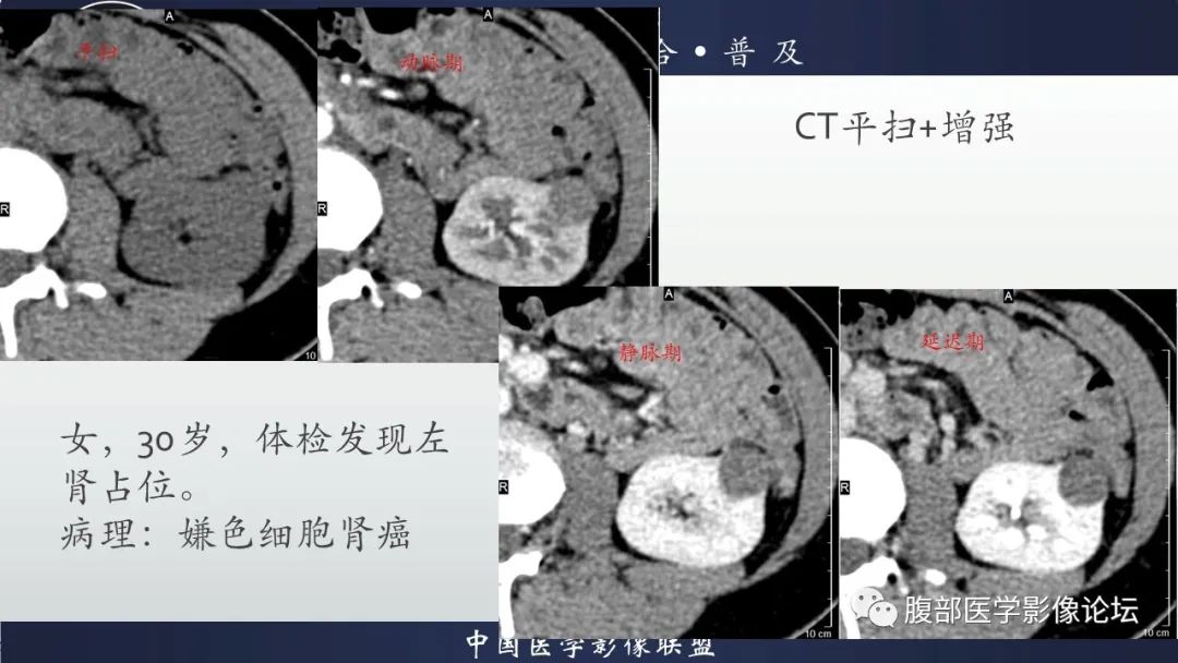 影像PPT - 【病例】肾球旁细胞瘤1例CT及MR影像诊断-28