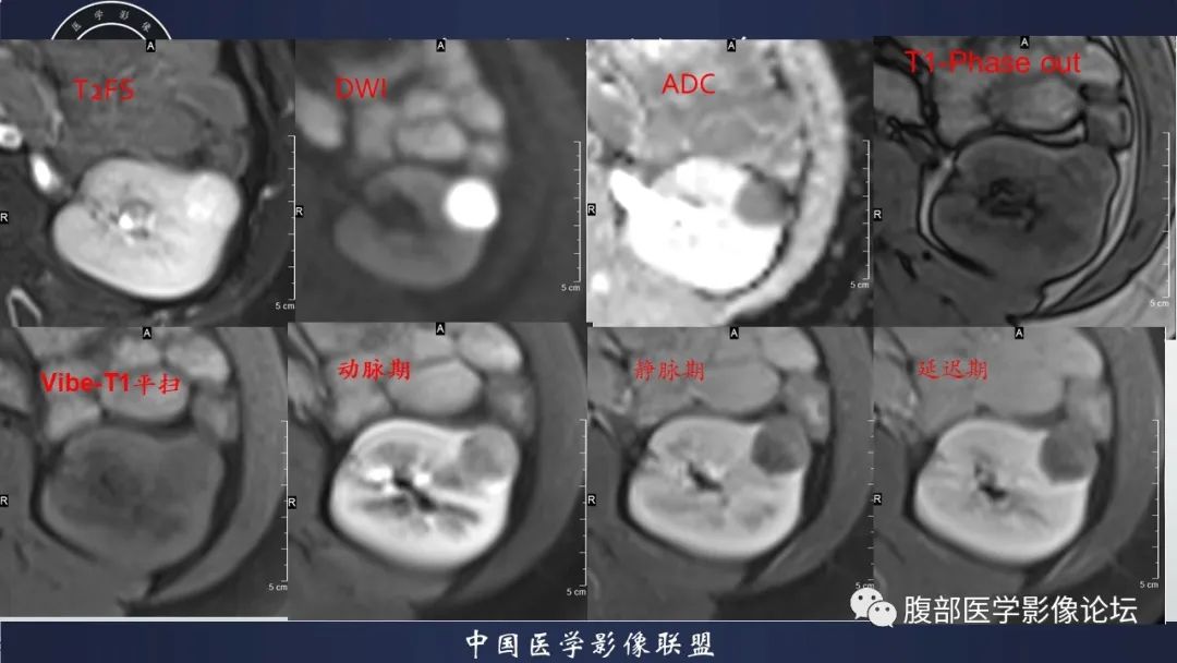 影像PPT - 【病例】肾球旁细胞瘤1例CT及MR影像诊断-29