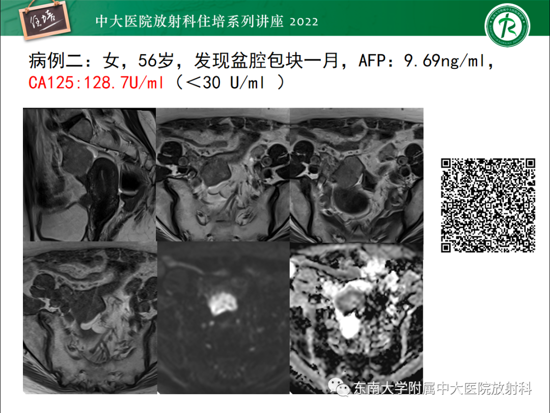 影像PPT - 【PPT】附件病变磁共振评分系统MRI O-RADS-5