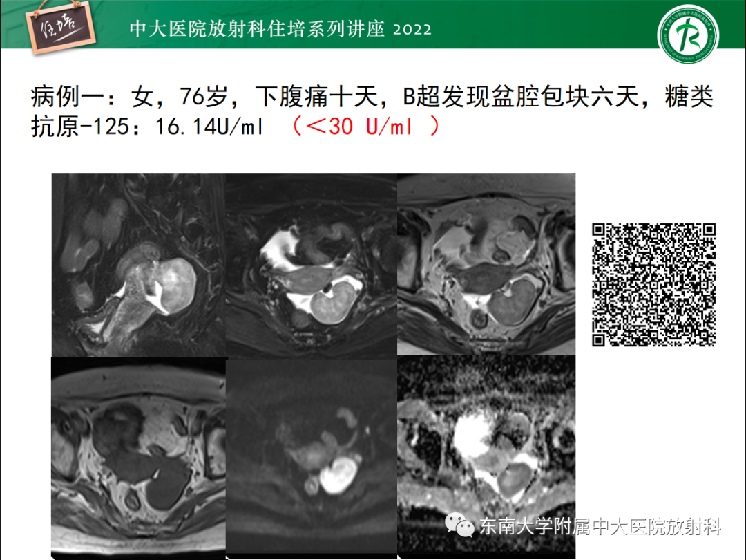 影像PPT - 【PPT】附件病变磁共振评分系统MRI O-RADS-4