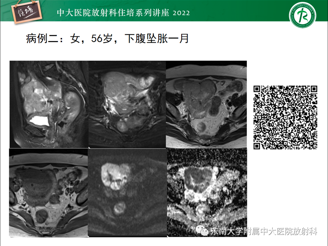 影像PPT - 【PPT】附件病变磁共振评分系统MRI O-RADS-8