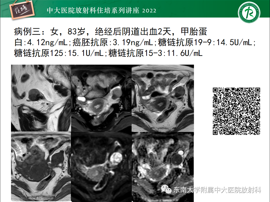 影像PPT - 【PPT】附件病变磁共振评分系统MRI O-RADS-6
