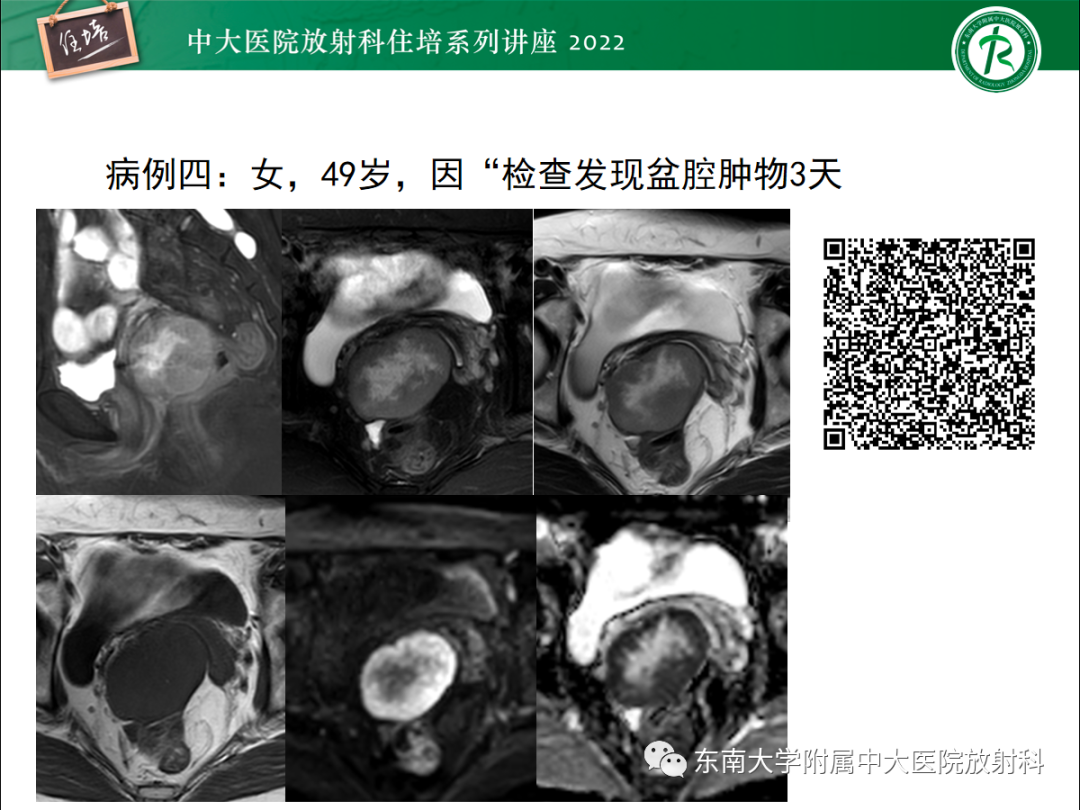 影像PPT - 【PPT】附件病变磁共振评分系统MRI O-RADS-7