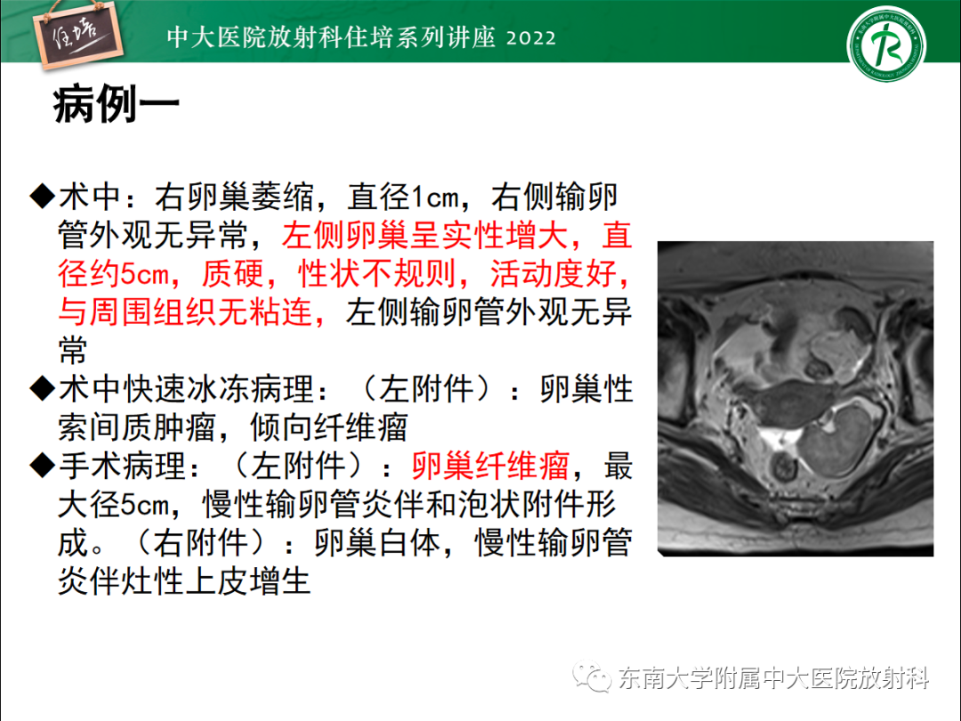 影像PPT - 【PPT】附件病变磁共振评分系统MRI O-RADS-9