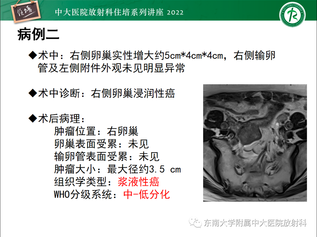 影像PPT - 【PPT】附件病变磁共振评分系统MRI O-RADS-10