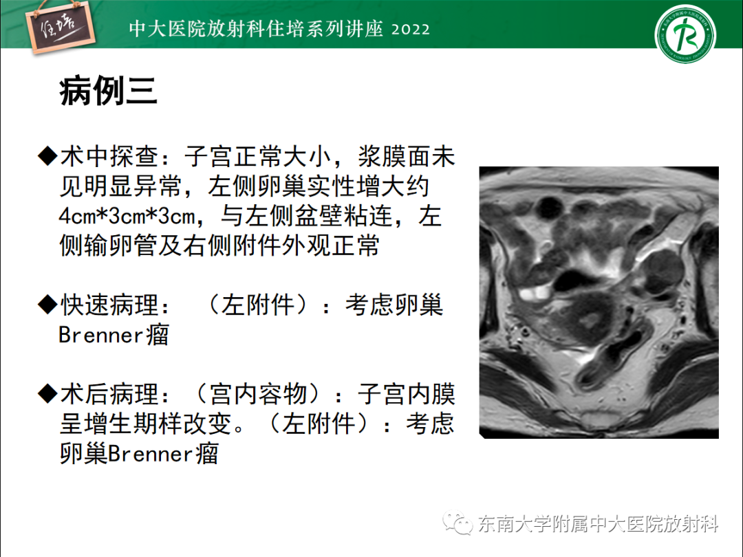影像PPT - 【PPT】附件病变磁共振评分系统MRI O-RADS-11