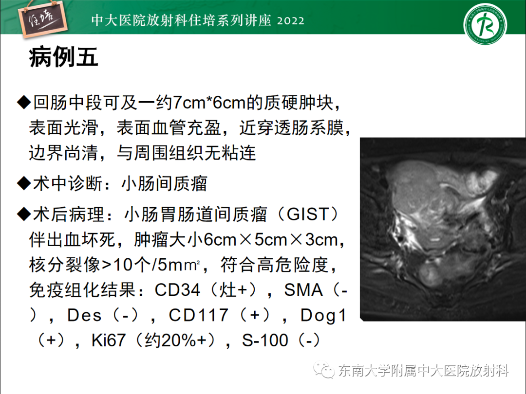 影像PPT - 【PPT】附件病变磁共振评分系统MRI O-RADS-13