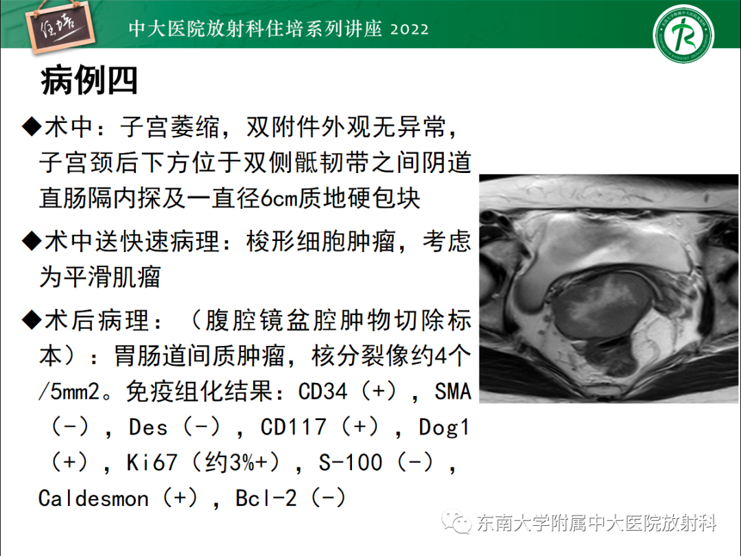 影像PPT - 【PPT】附件病变磁共振评分系统MRI O-RADS-12