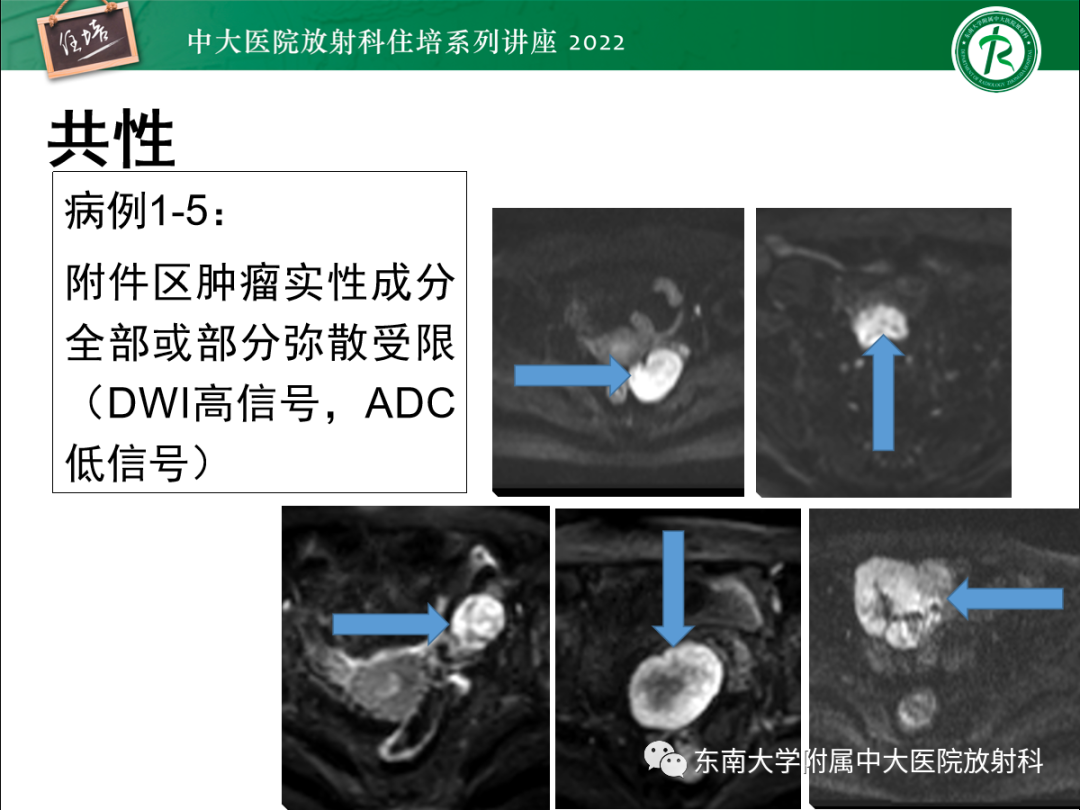 影像PPT - 【PPT】附件病变磁共振评分系统MRI O-RADS-14