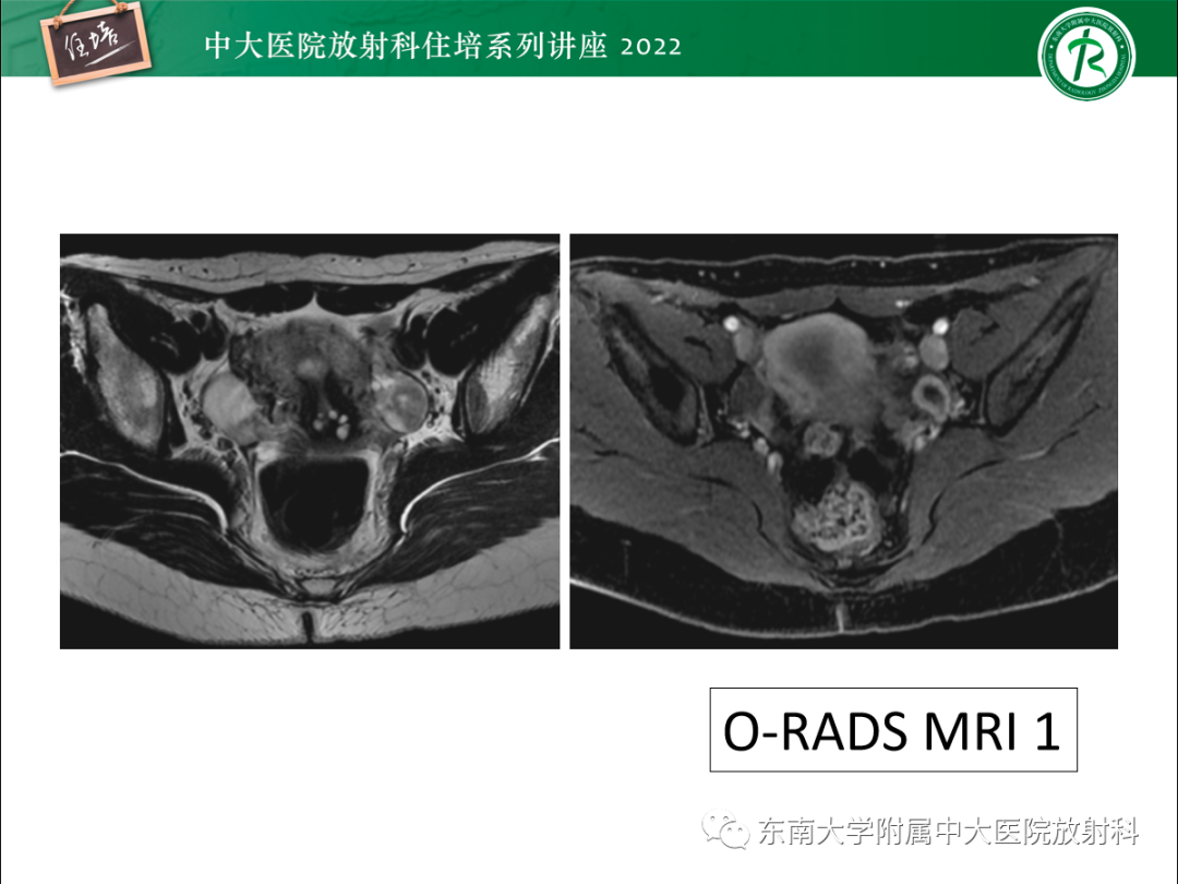 影像PPT - 【PPT】附件病变磁共振评分系统MRI O-RADS-21