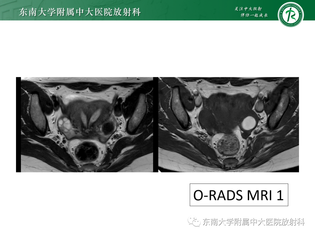 影像PPT - 【PPT】附件病变磁共振评分系统MRI O-RADS-22