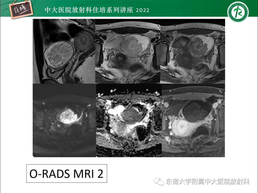 影像PPT - 【PPT】附件病变磁共振评分系统MRI O-RADS-26