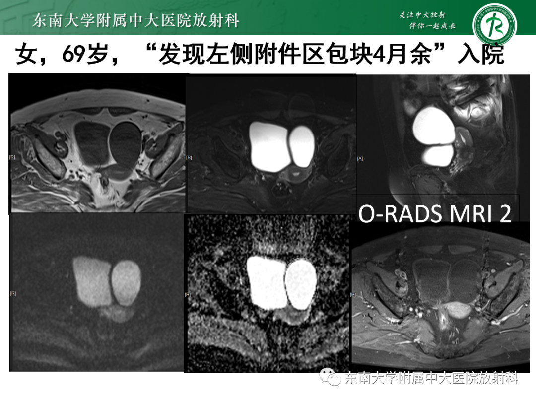 影像PPT - 【PPT】附件病变磁共振评分系统MRI O-RADS-25