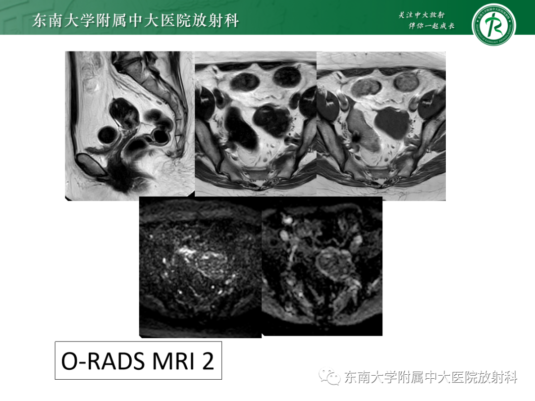 影像PPT - 【PPT】附件病变磁共振评分系统MRI O-RADS-27