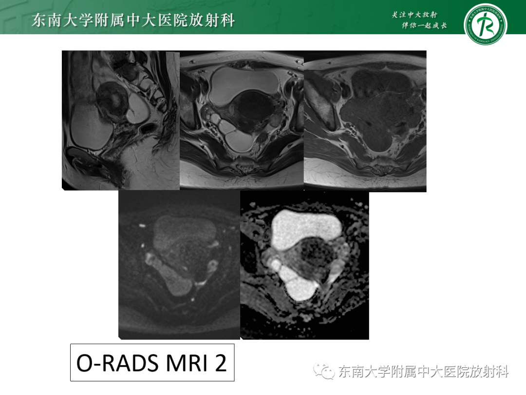 影像PPT - 【PPT】附件病变磁共振评分系统MRI O-RADS-28