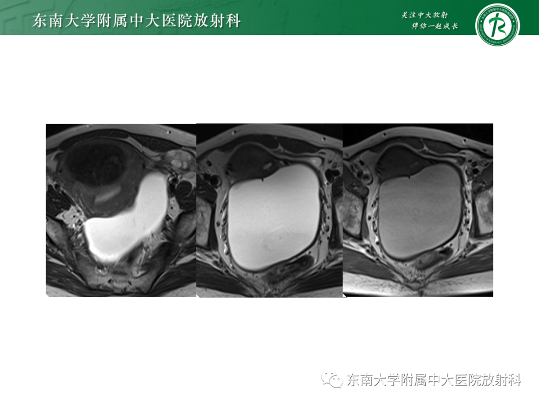 影像PPT - 【PPT】附件病变磁共振评分系统MRI O-RADS-30