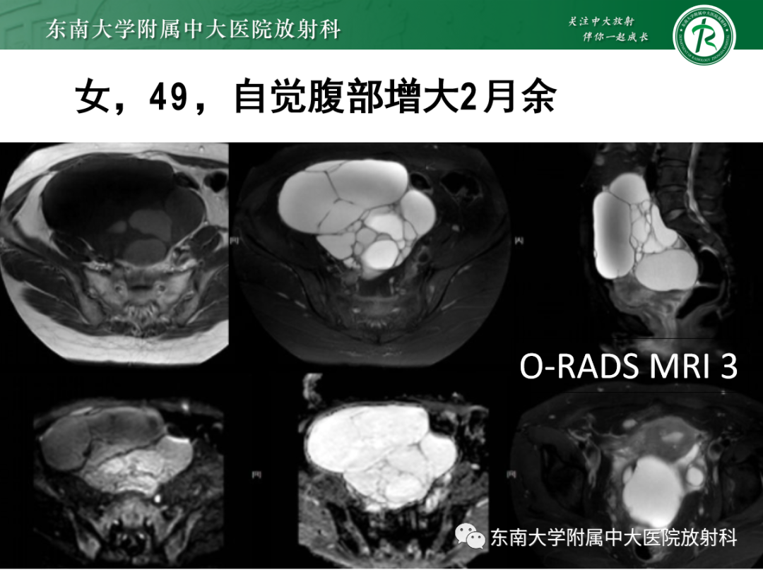影像PPT - 【PPT】附件病变磁共振评分系统MRI O-RADS-31