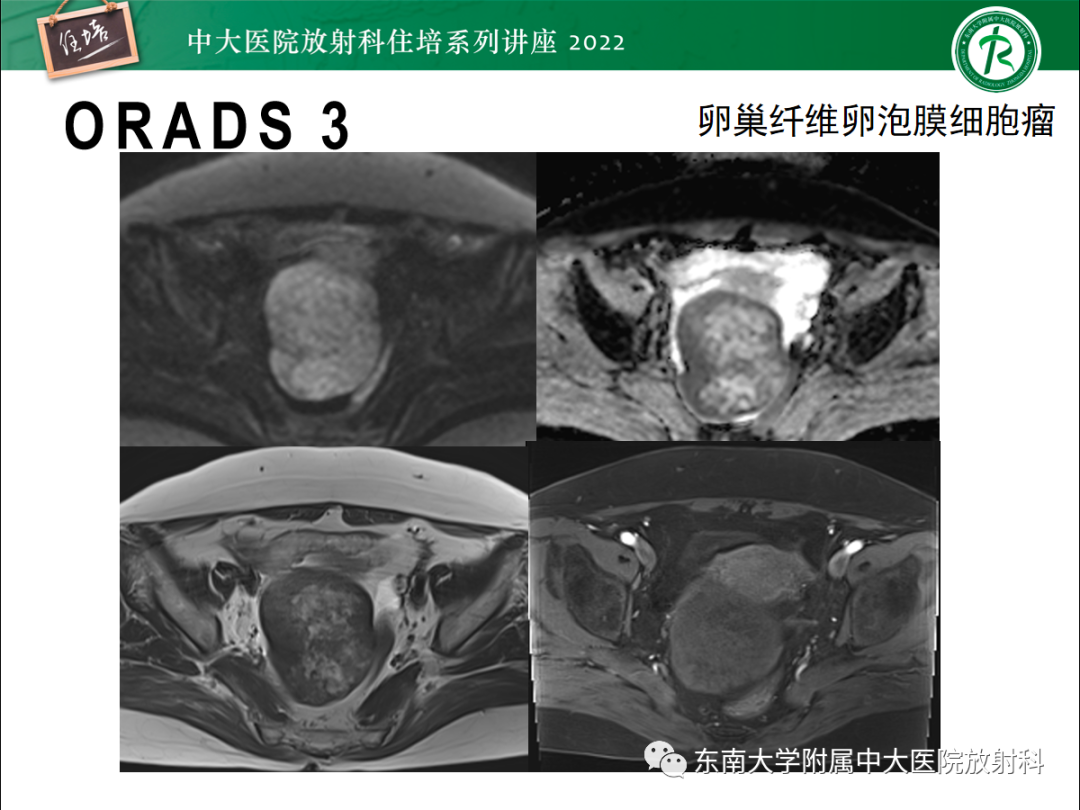 影像PPT - 【PPT】附件病变磁共振评分系统MRI O-RADS-34