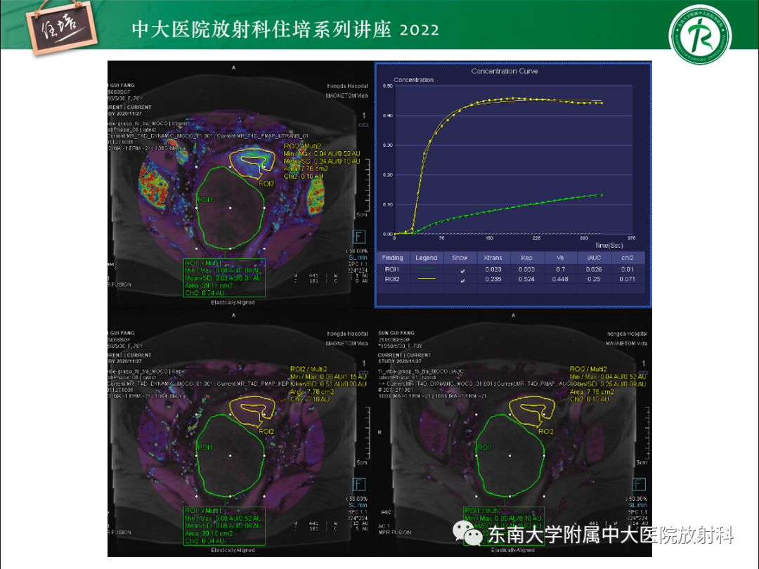 影像PPT - 【PPT】附件病变磁共振评分系统MRI O-RADS-33